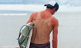 Sun Poisoning